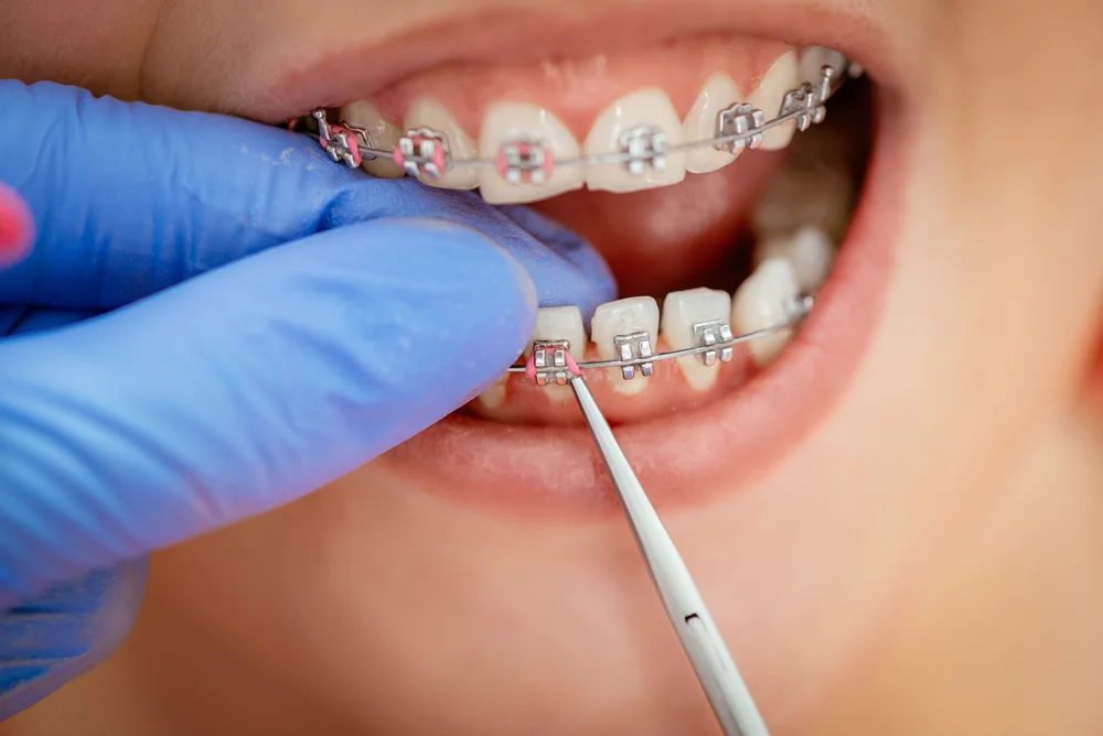 How Much Do Braces Cost?, Braces Price