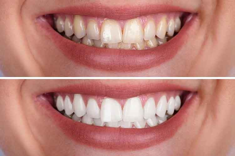 How Can I Get Rid of Yellowish Teeth?