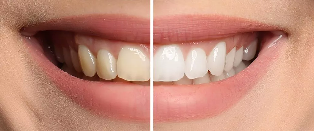 Reasons for Brown Stains on Your Teeth and How to Eliminate Them?